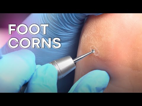 How To Fix Painful Corns Without Going to a Doctor