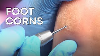 Corn removal and callus reduction - safe and easy!