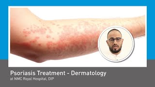 Psoriasis Treatment at NMC Royal Hospital, DIP