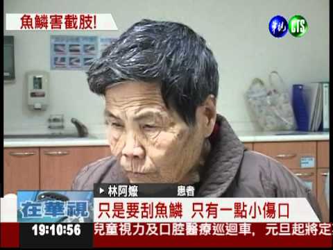 刮魚鱗染海洋弧菌 七旬阿嬤截肢