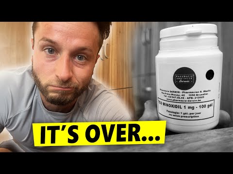 Oral Minoxidil - 12 Months UPDATE!