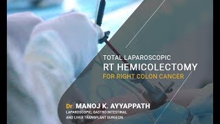 Total Laparoscopic RT Hemicolectomy for Right Colon Cancer