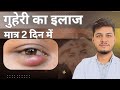 आंख की गुहेरी दूर करने के घरेलु उपाय Eye D