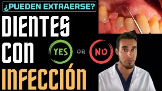¿Se puede sacar un DIENTE con INFECCIÓN La respuesta te sorprenderá