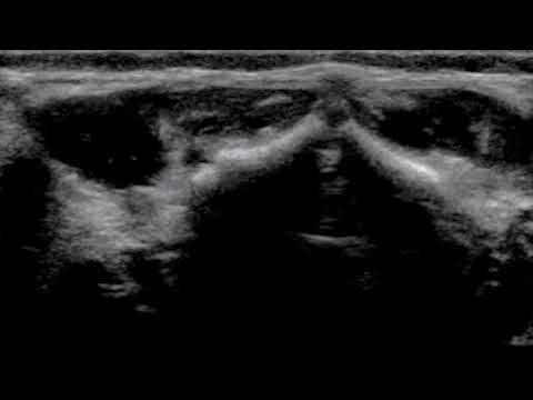 Spinal US - dorsal dermal sinus