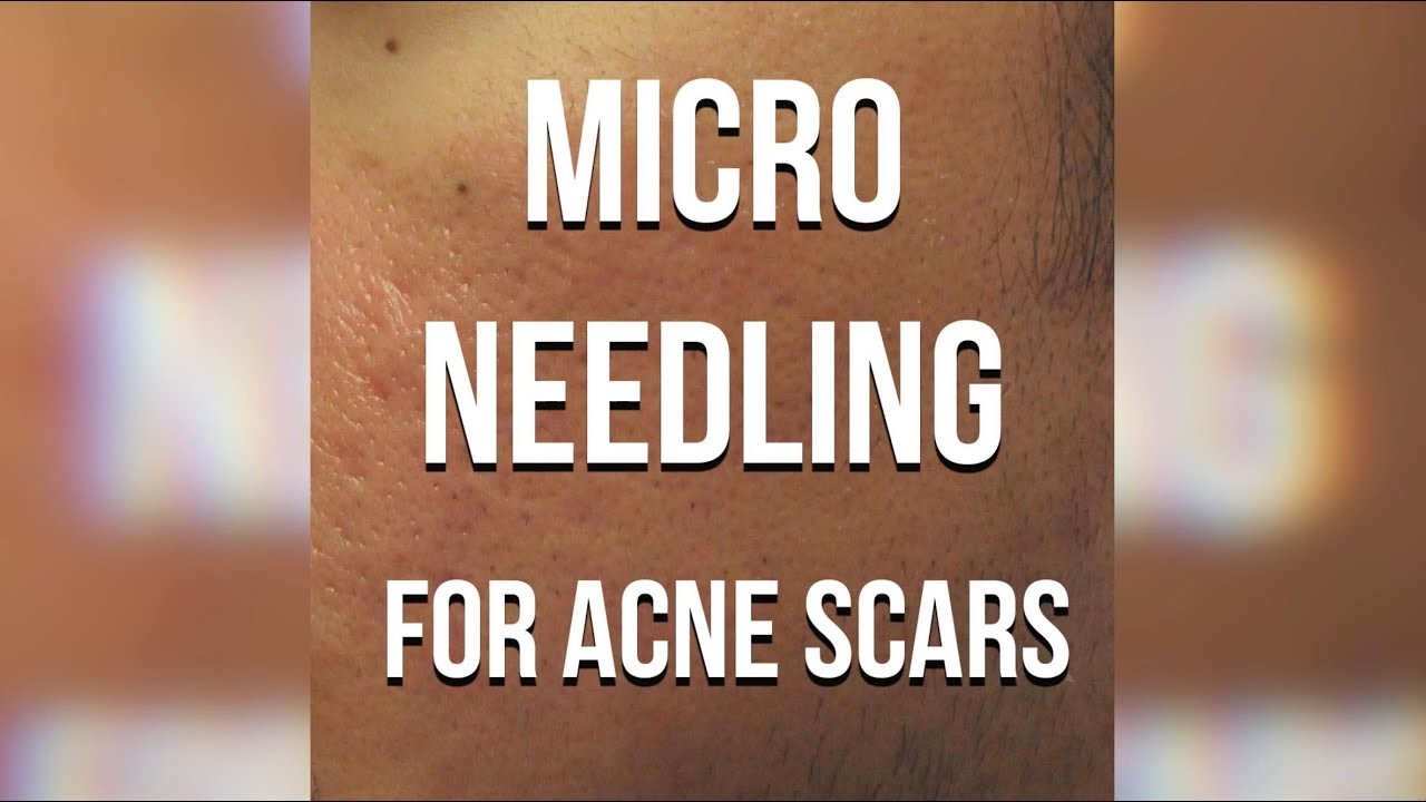 PRPmobile - Microneedling for Acne Scars