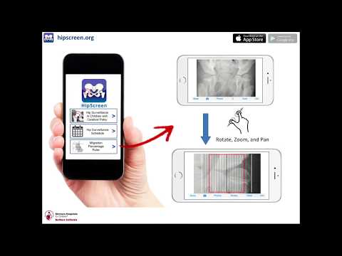 Watch lagu Images Videos Cerebral Palsy Hip Surveillance X Ray, Watch Images Cerebral Palsy Hip Surveillance X Ray free Watch, Watch Images Cerebral Palsy Hip Surveillance X Ray