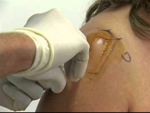 Esercizi per losteocondrosi cervicale toracica Dolore allanca da malattia degenerativa del disco