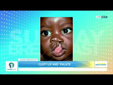 Cleft Lip and Palate: Dr Oum-Kalsoum Zakaria Adam Explains What Parents Should Know