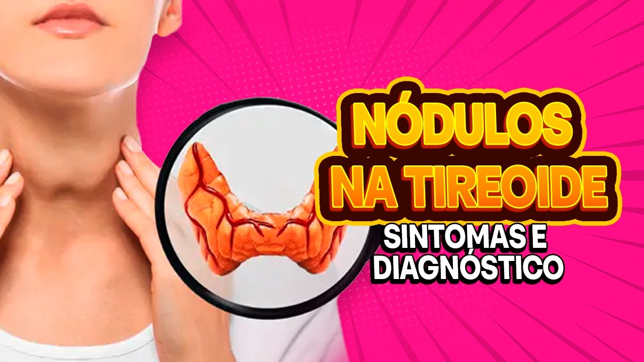 Nódulos na Tireoide: Diagnóstico e Sintomas