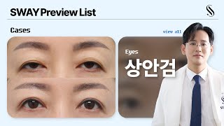 EYES PREVIEW. 눈이 처지고 짓물러요 | #상안검 #이마거상