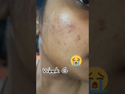 😭Watch before buying 10% Niacinamide serum testing for 6 weeks #shorts