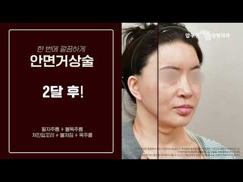 #안면거상술잘하는병원 찾으신다면? 목거상까지 싹! *
