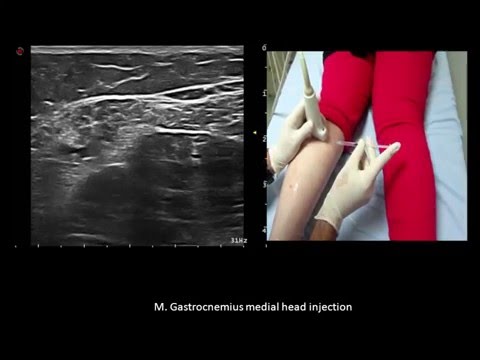 Ultrasound guided lower limb  botulinum toxin injections, by Murat Karkucak MD