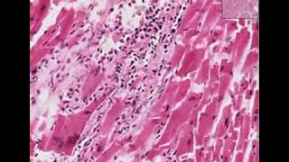 Histopathology Heart--Toxoplasma gondii myocarditis