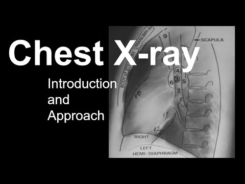 Chest X-ray: Introduction and Approach