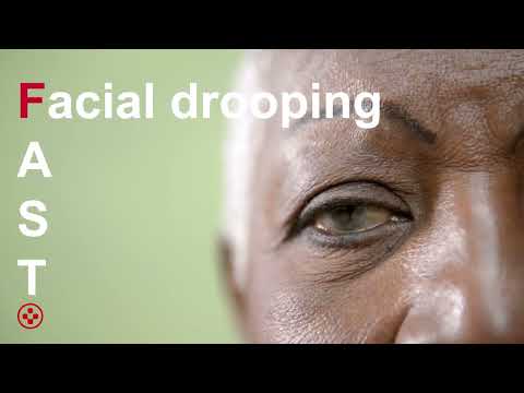 How to identify stroke FAST