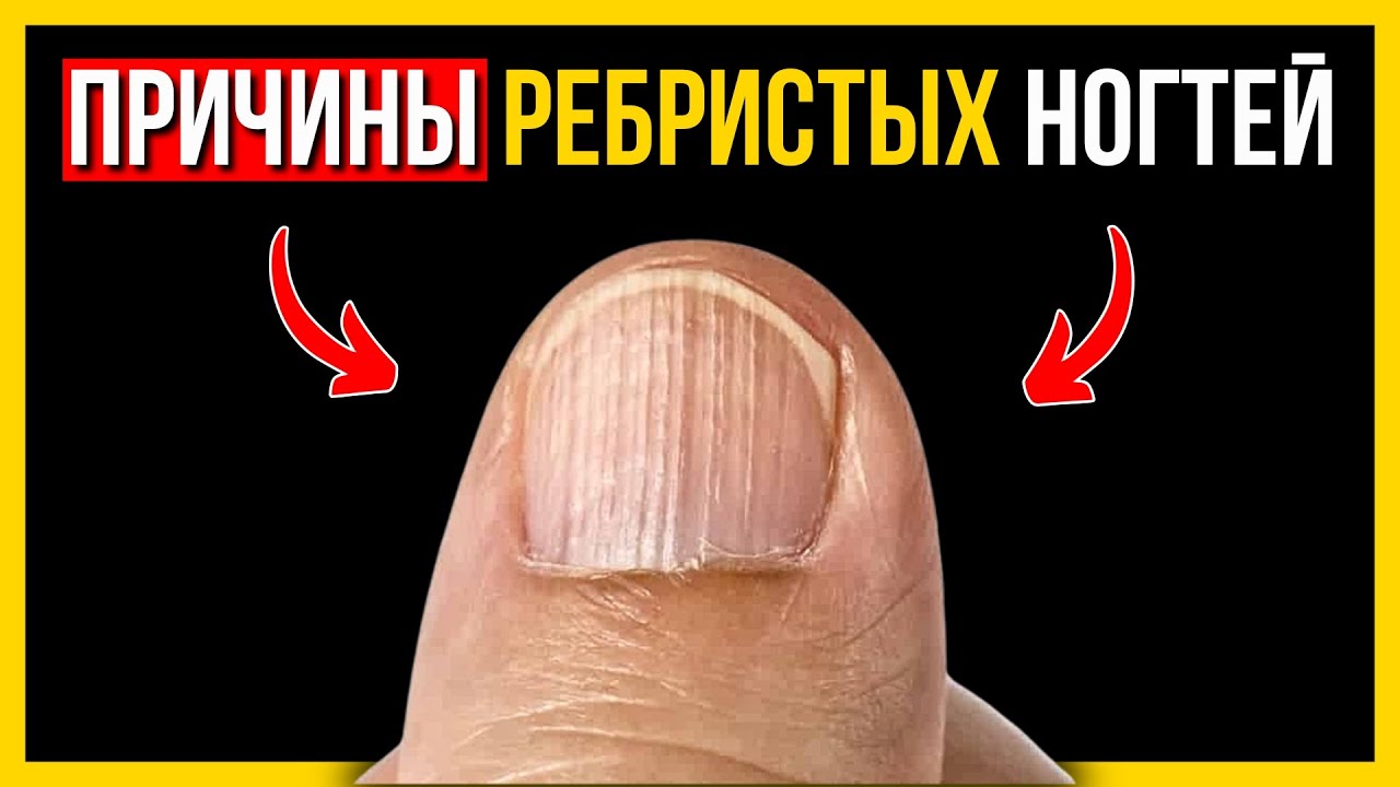 О чём кричат ВЕРТИКАЛЬНЫЕ БОРОЗДЫ на ногтях? Не лечите симптом, ищите ПРИЧИНУ✅