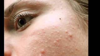 Combination Skin and "Mini Bumps"