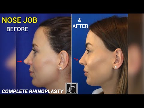 Nose Job Before & After - A Complete Rhinoplasty - Nose Job Experience with Before and After Results