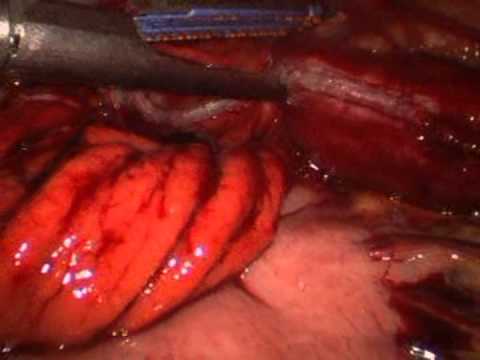 Two Techniques For Laparoscopic Resection Of Gastric Gists