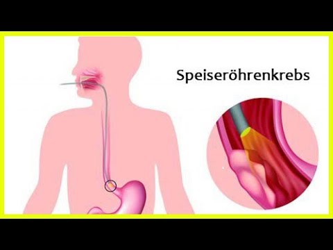 Blutdruck Orgasmus Hypertonie fliegt ein Flugzeug