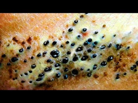 blackheads removing and extraction acne treatment 2021
