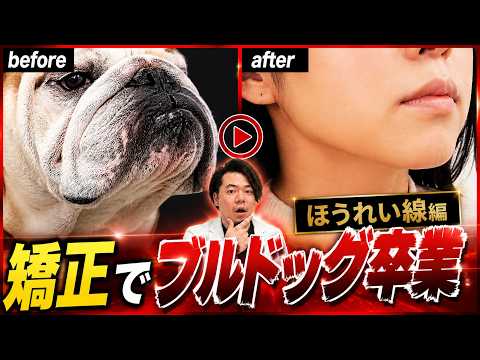 【ほうれい線編】矯正でブルドッグ卒業