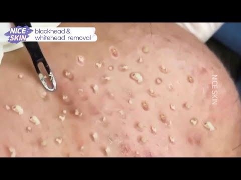 Blackhead & whitehead removal Video #2 #Blackheads #blackheadsremoval #sebum