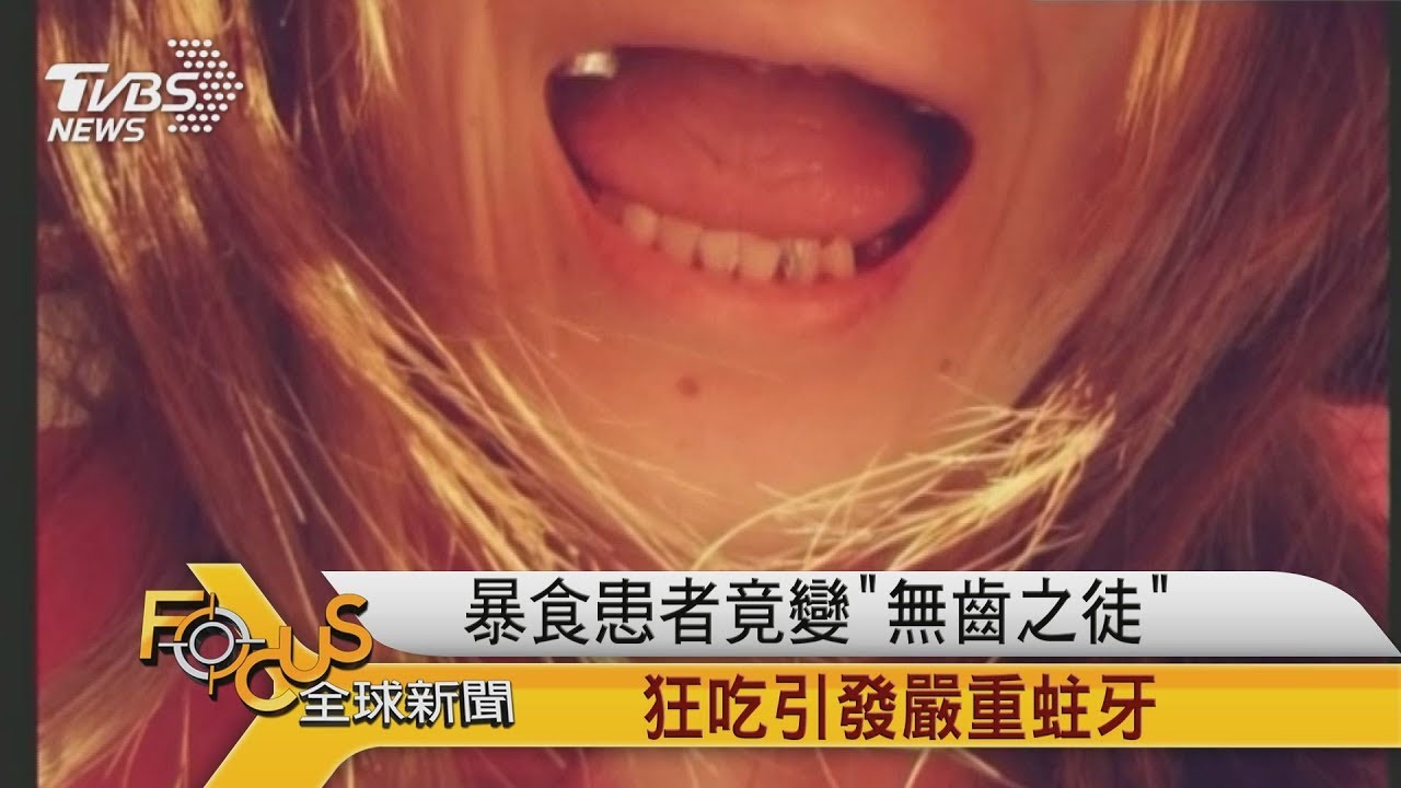 暴食患者竟變「無齒之徒」狂吃引發嚴重蛀牙