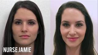 Before and After Facial Cupping - Nurse Jamie on E! News