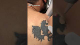 Download lagu Bagaimana Cara Tato Dihapus? mp3 Download lagu Bagaimana Cara Tato Dihapus? mp3