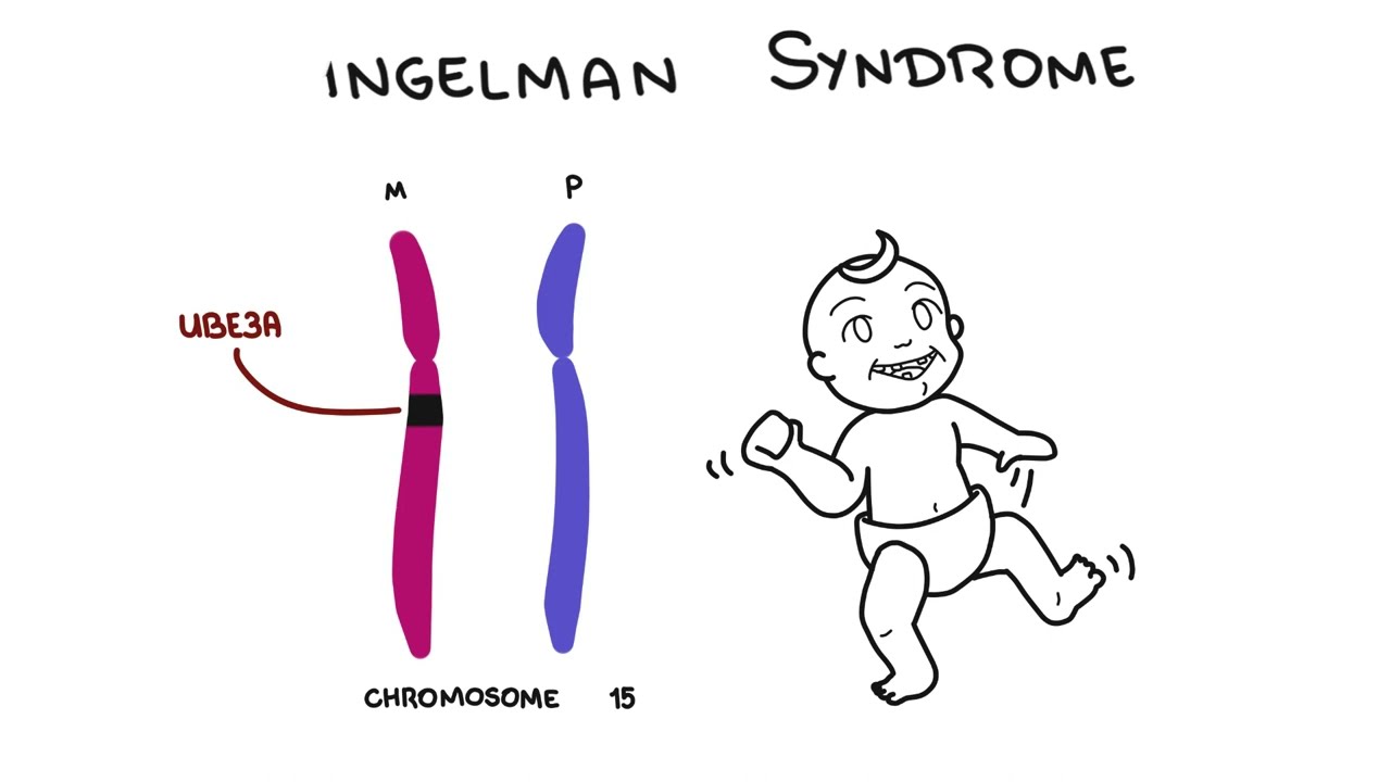 Angelman Syndrome