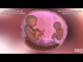Twin Twin Transfusion Syndrome TTTS