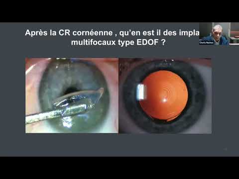 Presbylasik vs implant multifocal EDOF | C.Ghenassia