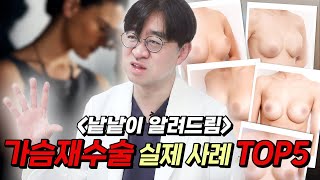 가슴재수술 실제 수술 사례로 수술 결과 확인하기