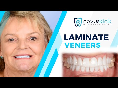 Smile Design With Lumineers : Check out the review video of lovely patient Mitzi from Florida !