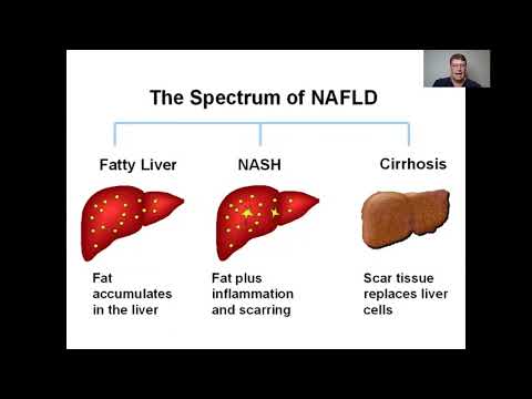FATTY LIVER DISEASE: SIMPLE CAUSE, SIMPLE CURE