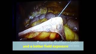 TPEA Lifter - Lymphadenectomy
