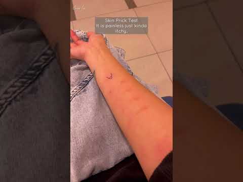 Allergy test done today 😊 #shorts #allergytest #crisalis