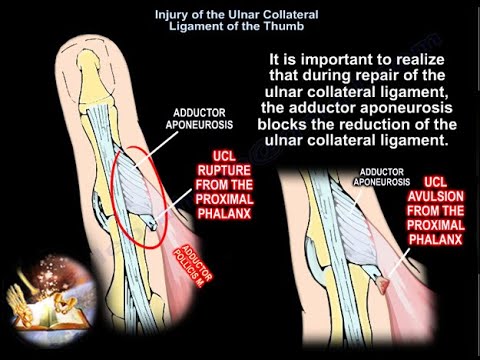 Lésion du Ligament Collatéral Ulnaire du Pouce -  Dr Nabil Ebraheim