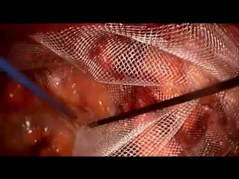 Übung für Arthrose des Gelenkes Bandscheibenbruch bei Männern