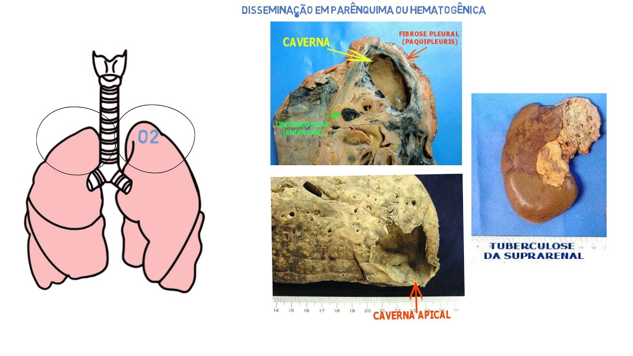 TUBERCULOSE - Fisiopatologia, diagnóstico e tratamento