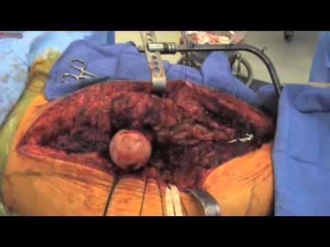 Limb-Salvage Surgery And Prosthetic Implantation Due To Chondrosarcoma