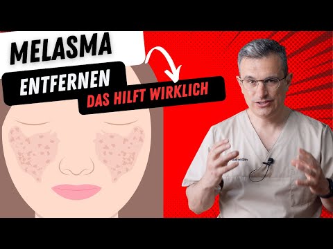 Melasma entfernen, Tipps vom Hautarzt. Dr. Kasten Hautmedizin in Mainz