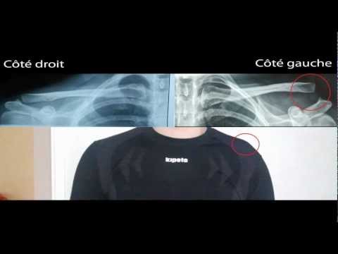 comment soulager fracture clavicule