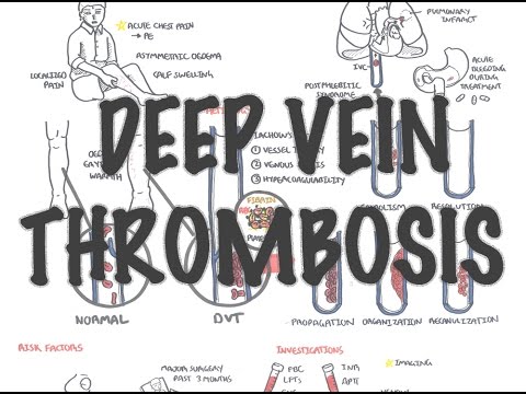 Deep Vein Thrombosis - Overview (pathophysiology, treatment, complications)