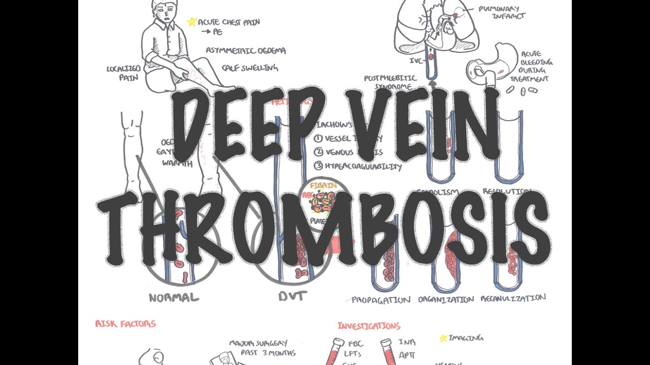 Deep Vein Thrombosis - Overview (pathophysiology, treatment, complications)