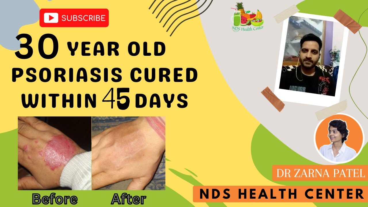 30 Year Old Psoriasis Healed Within 45 days By Dr. Zarna Patel (NDS) | New Diet System