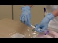 How To Advance And Rotate A Corflo PEG Percutaneous Endoscopic Gastrostomy